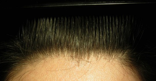 Alopecia androgenetica dai 20 ai 30 anni.